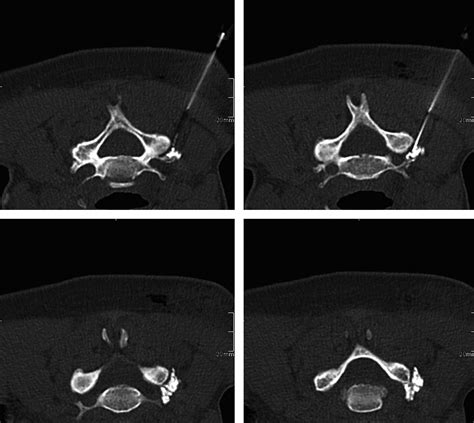 Ct Guided Cervical Selective Nerve Root Block With A Dorsal Approach