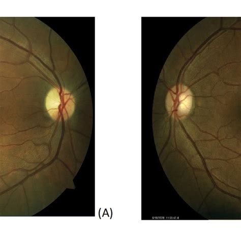 Color Fundus Photography Of Both Eyes A Fundus Photo Of The Right
