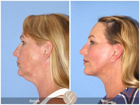 Facelift Fifties Before And After Photos Patient 62 Dr Kevin Sadati