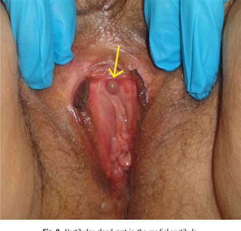 Figure From Benign Lumps And Bumps Of The Vulva A Review