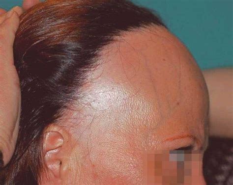 Principales Tipos De Alopecia Femenina Mujer Mujer Con Salud