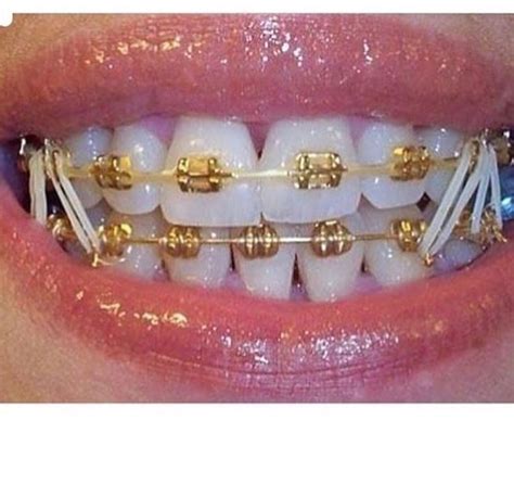 Pin By Carly On Things To Do Dental Braces Braces Colors Cute Braces Colors