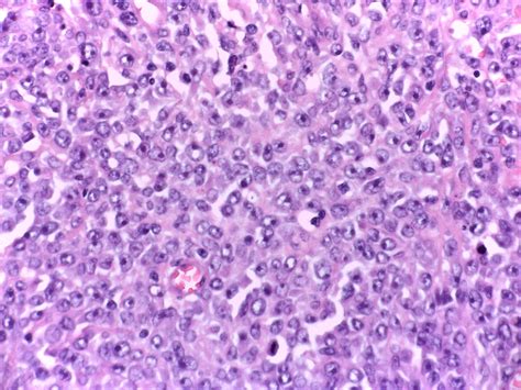 Diffuse Large B Cell Lymphoma Of Ileum Gross Pathology And Histology