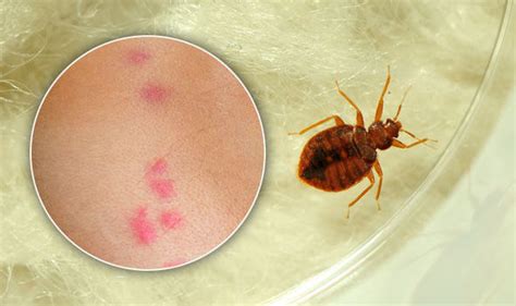 Have you been bitten by bed bugs? Bed bug bites: Signs and symptoms of insect bites - how to ...