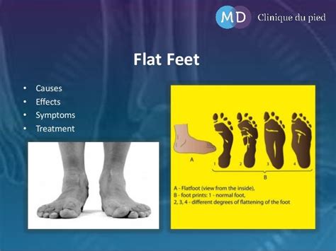Flat Feet Causes Effects Symptoms And Treatment
