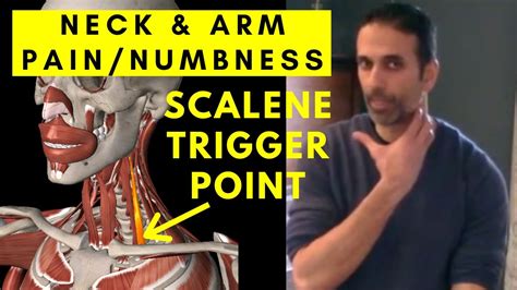 Neck And Arm Pain Relief Scalene Muscle Trigger Points Youtube