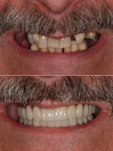 Teeth In A Day All On Four Procedure North York Toronto
