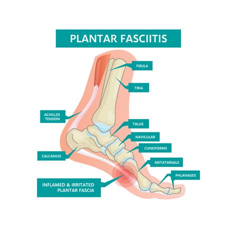 what is plantar fasciitis know causes and symptoms