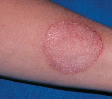 Tinea Infections As Related To Fungal Infections Pictures