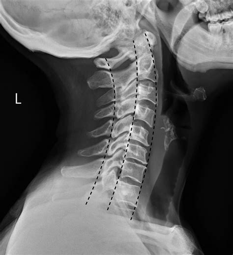 Cervical Spine Radiology Anaesthesia And Intensive Care Medicine