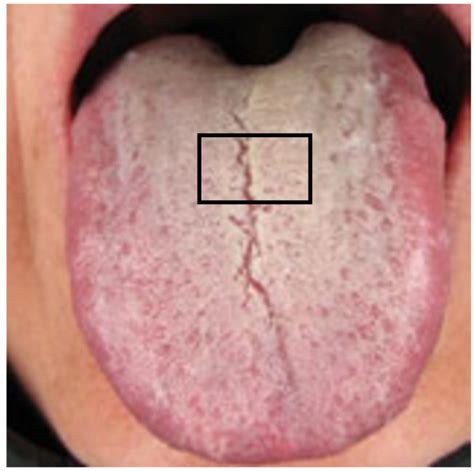 Diagnosis Tongue Problems