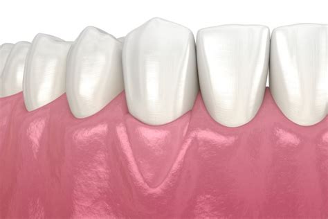 What Happens In A Gum Graft Procedure From A Periodontist Prosoft