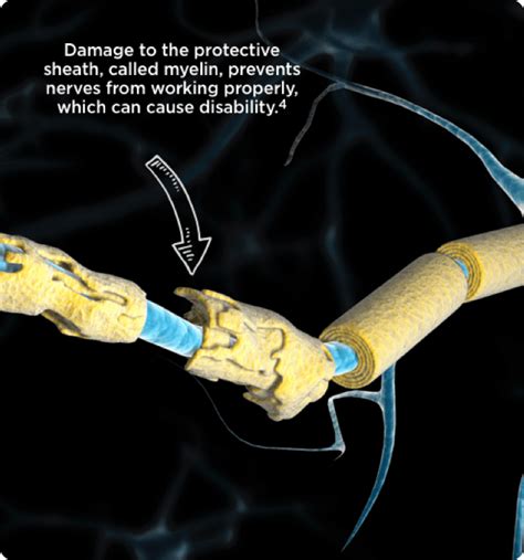 Understanding Cidp And The Symptoms Official Site For Patients Gamunex® C