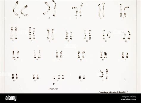 Karyotype Of Trisomy 21 Hi Res Stock Photography And Images Alamy