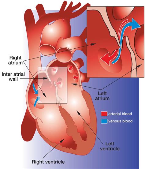 Patent Foramen Ovale The Heart And Diving Dan Health Issues And Diving