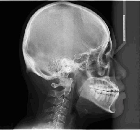 Occipital Spur Understanding A Normal Yet Symptomatic Variant From