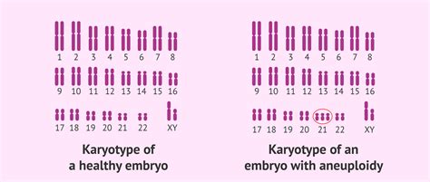 What Is Embryonic Aneuploidy