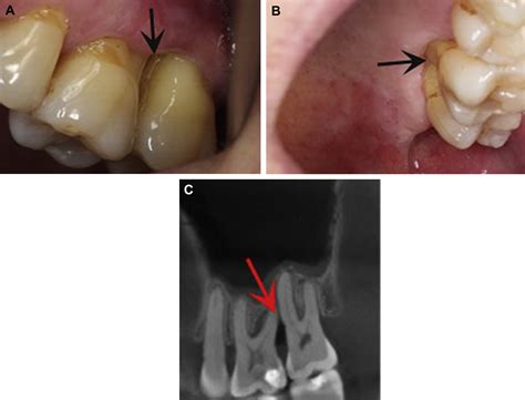 Osteonecrosis Of The Jaw In The Absence Of Antiresorptive Or