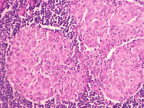 Lymph Nodes With Noncaseating Epithelioid Cell Granulomas Of