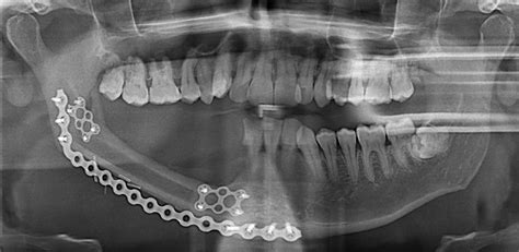 Bone Reconstruction Options For The Mandible — Matlab Number One