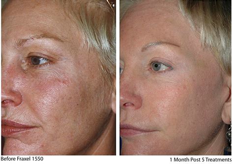 Fraxel Treatments at Medical Aesthetic Center