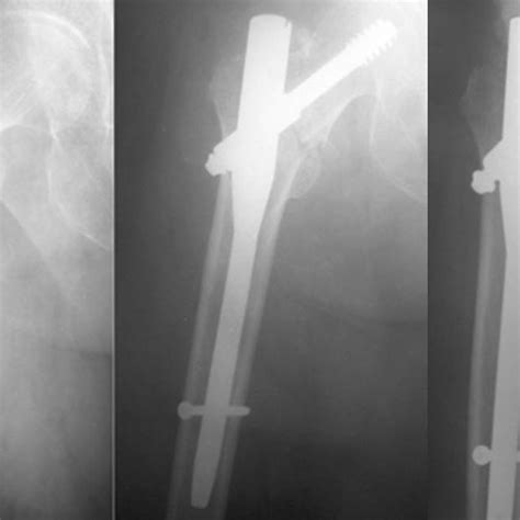 A Anteroposterior Radiograph Of The Right Hip Joint Showing A Stable