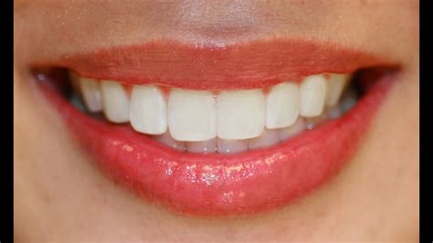 Teeth Treat How To Get Perfect White Teeth
