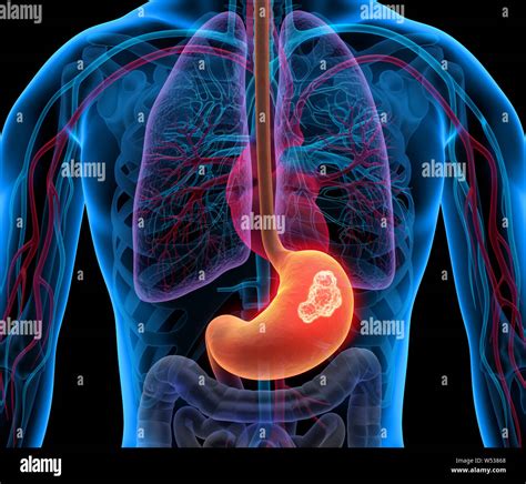 Cancer Stomach Tumor 3d Illustration Stock Photo Alamy