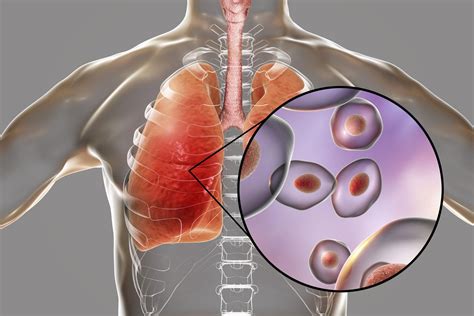 Pneumocystozowe Zapalenie Płuc Pneumocystoza Przyczyny Objawy
