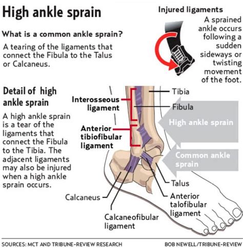 The High Ankle Sprain