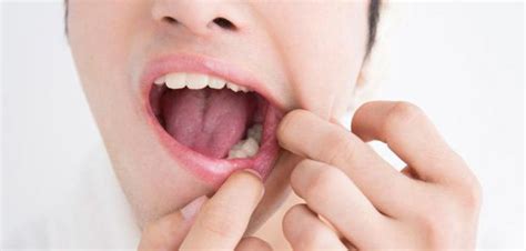 zapalenie okostnej zęba objawy przyczyny diagnostyka leczenie My XXX Hot Girl