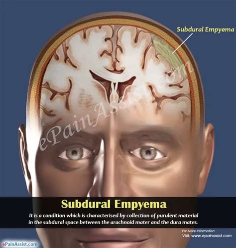Subdural Empyema Causes Symptoms Treatment Pathophysiology