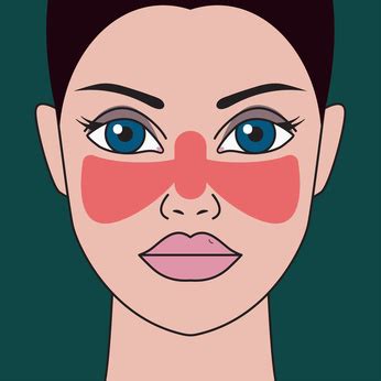 Lupus, technically known as systemic lupus erythematosus (sle), is an autoimmune disease in which the body's immune system mistakenly attacks healthy tissue in many parts of the body. Lupus Krankheit heilen mit Chaga Tee - (TIPPS & TRICKS)