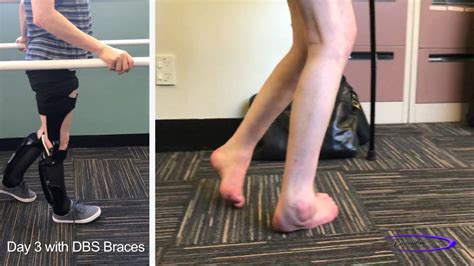Spastic Paraplegia Before Vs Day With Dbs Leg Braces Youtube