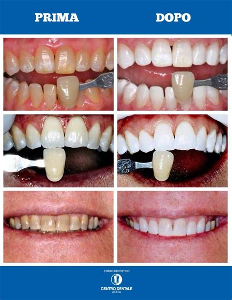 Sbiancamento Denti Come Funziona E Quando Farlo