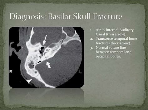 Basal Skull Fracture Signs Basal Skull Fractures This Type Of