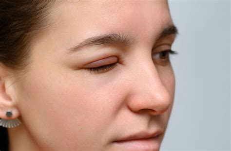 What Causes Swollen Eyelids All About Vision