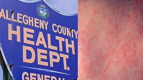 Measles Case Identified Bus Riders May Have Been Exposed