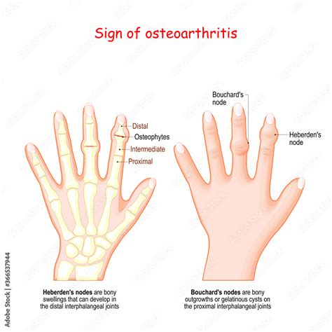 Vecteur Stock Sign Of Osteoarthritis Human Hand With Heberden S Node