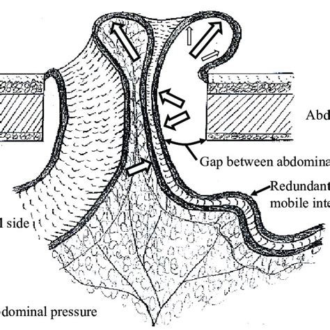 Mechanism Of Stoma Prolapse Fig 1 Mechanism Of Stoma Prolapse Cited