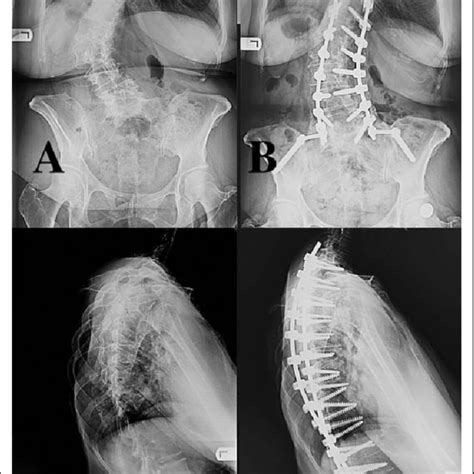 Ap And Lateral Standing Radiographs Of The Same Patient Preoperatively