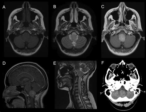 Preoperative Imaging Axial Mri Slices At The Level Of The Medulla