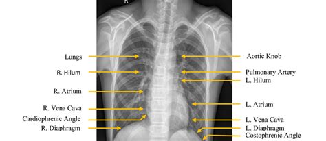 Normal Pa Chest X Ray Demonstrating Normal Anatomy Download