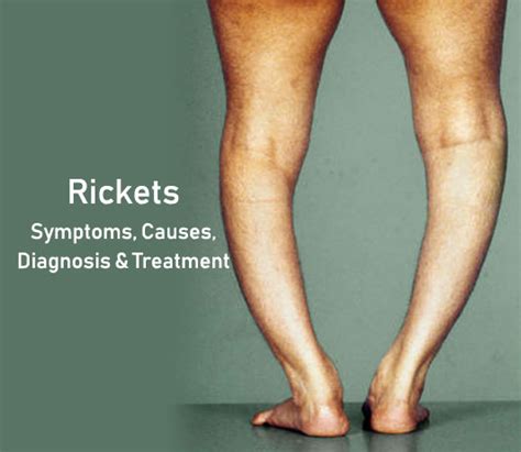 Understanding Rickets Causes Symptoms And Treatment Options