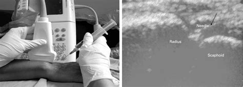 Ultrasound Guided Intra Articular Injections In The Wrist In Patients