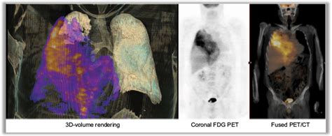 Being older than 60 and having mesothelioma on the left side of the chest were both linked to shorter survival. Full text Clinical staging of malignant pleural ...