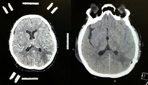 Contrast Enhanced Ct Scan Of The Left Side Of The Brain Showing