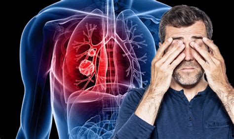 Lung Cancer Symptoms Signs Can Include Changes In Your Face Express