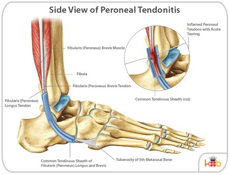Peroneal Tendonitis Treatment