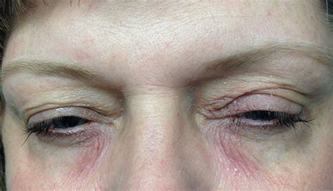 Derm Dx Itchy Rash On The Eyelid Clinical Advisor